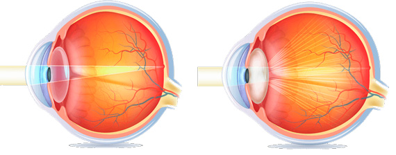 Основні симптоми катаракти