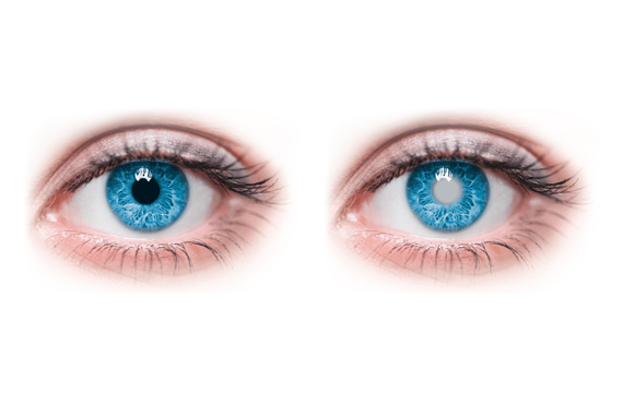 Причини виникнення катаракти 