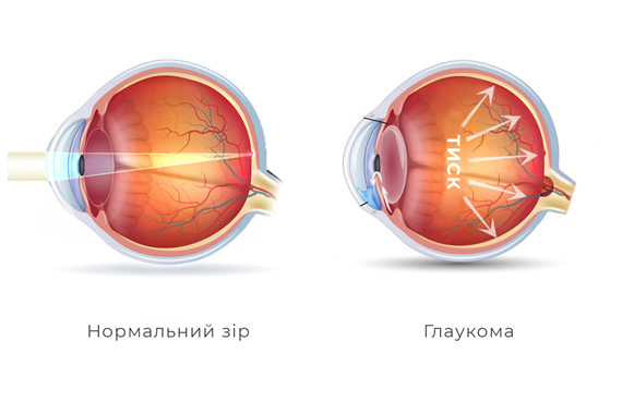 методи лікування глаукоми сергієнко